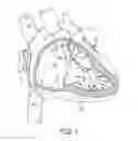 Fig. 02 - Interventional medical systems, devices, and components thereof