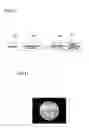 Fig. 08 - AUDITORY CANAL CLEANING TOOL AND AUDITORY CANAL OBSERVING TOOL