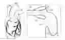 Fig. 01 - Treatment of appendage openings