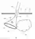 Fig. 03 - Methods and devices for removing a tissue specimen from a patient