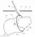 Fig. 04 - Methods and devices for removing a tissue specimen from a patient