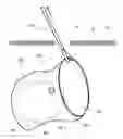 Fig. 05 - Methods and devices for removing a tissue specimen from a patient