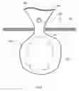 Fig. 07 - Methods and devices for removing a tissue specimen from a patient