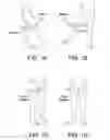 Fig. 02 - Method and apparatus for distracting a joint