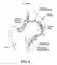 Fig. 07 - Method and apparatus for distracting a joint