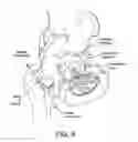 Fig. 10 - Method and apparatus for distracting a joint