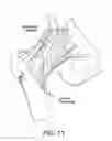 Fig. 12 - Method and apparatus for distracting a joint