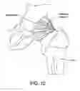 Fig. 13 - Method and apparatus for distracting a joint