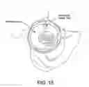 Fig. 16 - Method and apparatus for distracting a joint