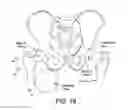 Fig. 17 - Method and apparatus for distracting a joint