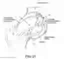 Fig. 20 - Method and apparatus for distracting a joint