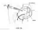Fig. 22 - Method and apparatus for distracting a joint