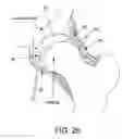 Fig. 28 - Method and apparatus for distracting a joint