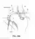 Fig. 30 - Method and apparatus for distracting a joint