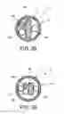 Fig. 31 - Method and apparatus for distracting a joint