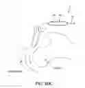 Fig. 44 - Method and apparatus for distracting a joint