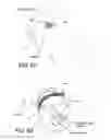 Fig. 47 - Method and apparatus for distracting a joint