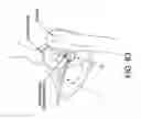 Fig. 56 - Method and apparatus for distracting a joint