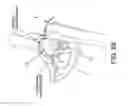 Fig. 58 - Method and apparatus for distracting a joint