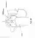 Fig. 60 - Method and apparatus for distracting a joint