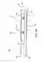 Fig. 67 - Method and apparatus for distracting a joint