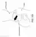 Fig. 76 - Method and apparatus for distracting a joint