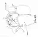 Fig. 80 - Method and apparatus for distracting a joint