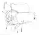 Fig. 85 - Method and apparatus for distracting a joint