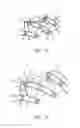 Fig. 14 - Methods and devices for the prevention of incisional surgical site infections