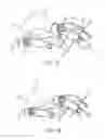 Fig. 16 - Methods and devices for the prevention of incisional surgical site infections