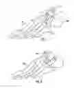 Fig. 06 - Bone implant with means for multi directional force and means of insertion