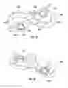 Fig. 31 - Bone implant with means for multi directional force and means of insertion