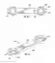 Fig. 34 - Bone implant with means for multi directional force and means of insertion