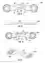 Fig. 38 - Bone implant with means for multi directional force and means of insertion
