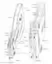 Fig. 59 - Bone implant with means for multi directional force and means of insertion