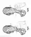 Fig. 09 - Device for a patient-specific acetabulum reaming and cup positioning guide