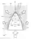Fig. 43 - Methods and devices for soft tissue dissection