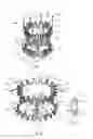 Fig. 02 - Minimally invasive mitral valve replacement with brim