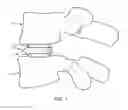 Fig. 02 - EXPANDABLE FUSION DEVICE FOR POSITIONING BETWEEN ADJACENT VERTEBRAL BODIES