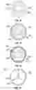 Fig. 07 - Stent deployment and postdilatation non-compliant balloon catheter and methods of use