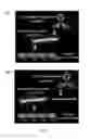 Fig. 02 - Targeting immunotherapy for amyloidosis