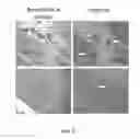 Fig. 07 - Targeting immunotherapy for amyloidosis