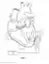 Fig. 06 - Crenellated inflow cannula
