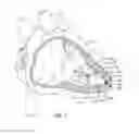 Fig. 02 - Extraction devices configued to extract chronically implanted medical devices