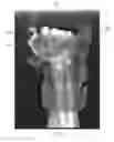Fig. 08 - X splint hand protection device