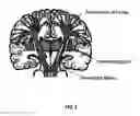 Fig. 02 - Edema invariant tractography