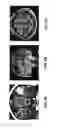 Fig. 04 - Edema invariant tractography