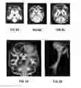 Fig. 09 - Edema invariant tractography