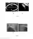 Fig. 07 - Probe for iridocorneal angle imaging