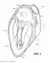 Fig. 02 - Methods for closing the left atrial appendage